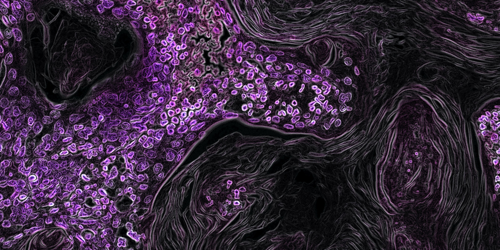 Kras-Driven Lung Cancer | photo by Eric Snyder